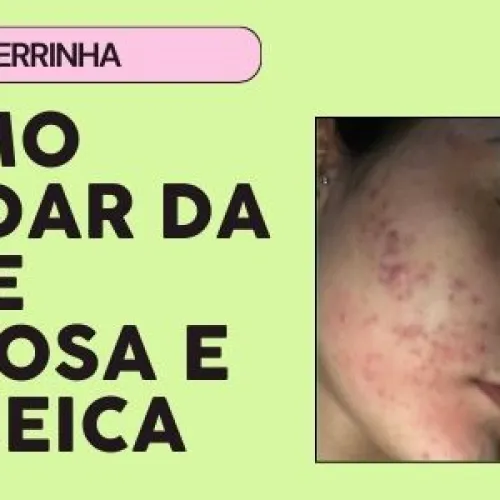 O que usar em peles oleosas e acneicas?